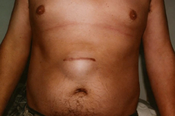 Incisional Hernia